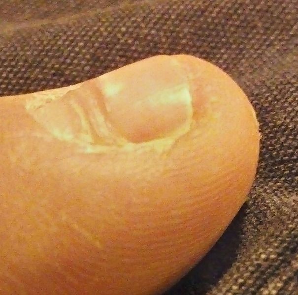 博氏线(图片来源:wikipedia) 其中,维生素b缺乏可能导致指甲横纹的