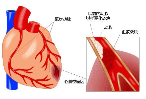 冠状动脉粥样硬化