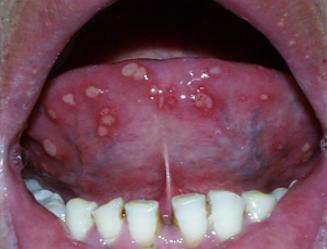 口腔溃疡超过1个月没好?小心口腔黏膜发生恶变