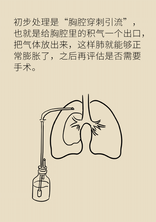 胸闷胸痛别大意 双侧气胸要人命(图15)